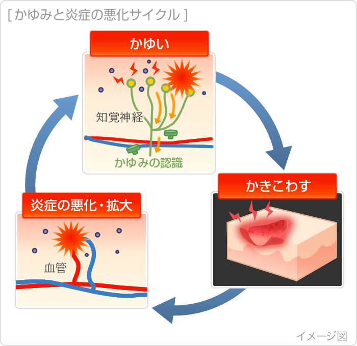 かゆみと炎症の悪化サイクル