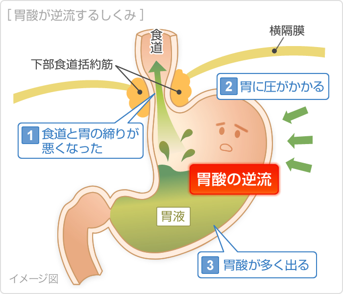 胃酸が逆流するしくみ