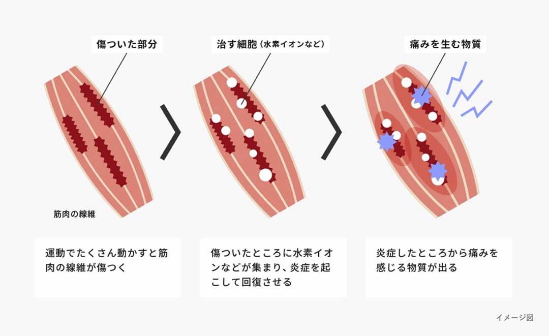 筋肉痛が発生する仕組みのイラスト