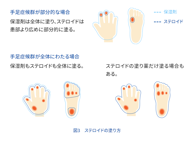 図3　ステロイドの塗り方