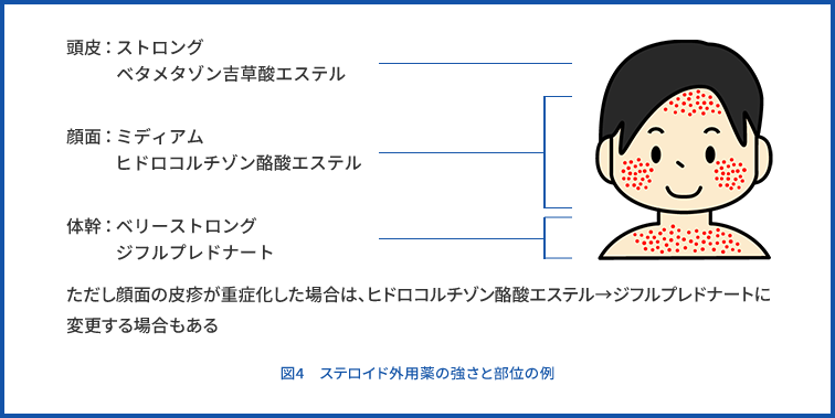 図4　ステロイド外用薬の強さと部位の例