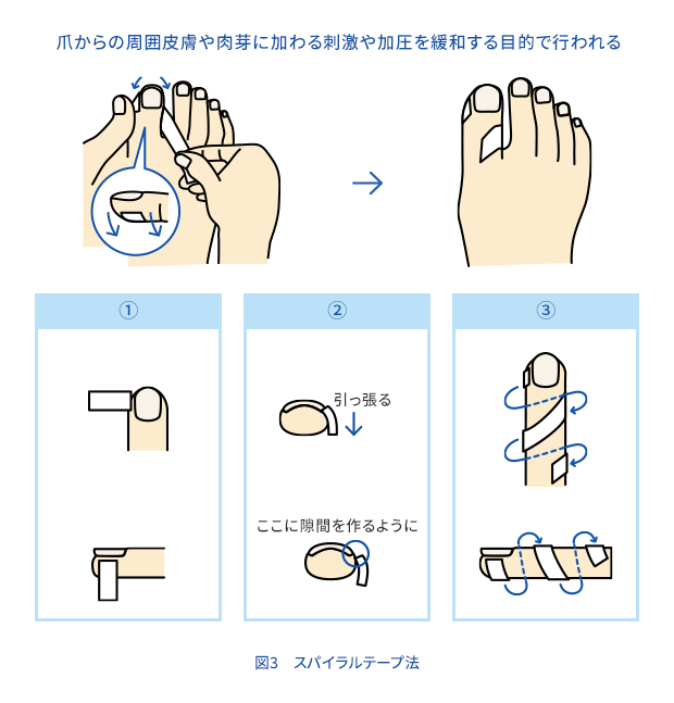 図3　スパイラルテープ法