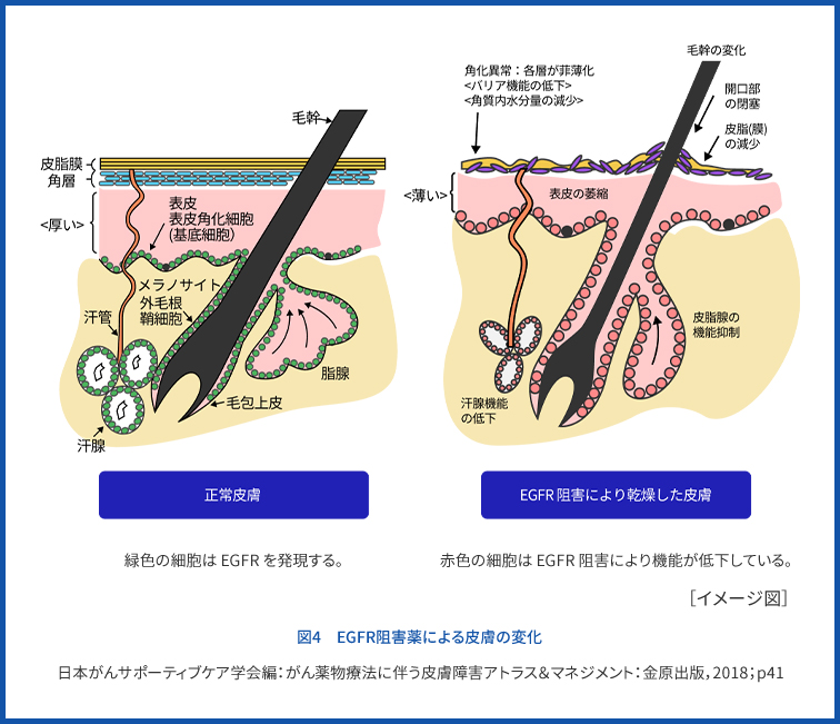 図3　EGFR阻害薬による皮膚の変化 日本がんサポーティブケア学会編：がん薬物療法に伴う皮膚障害アトラス＆マネジメント，東京：金原出版，2018；p41