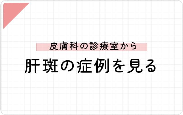 皮膚科の診察室から―肝斑の症例を見る―