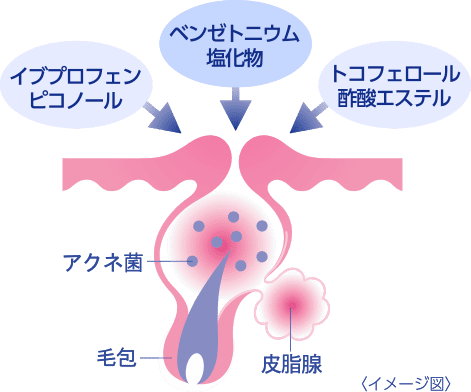 ベンゼトニウム塩化物・イブプロフェンピコノール・トコフェロール酢酸エステルがニキビにアプローチしているイメージ図