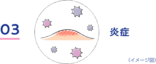 03炎症のイメージ図