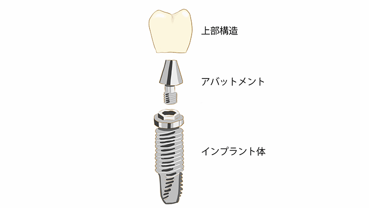 インプラントの構造