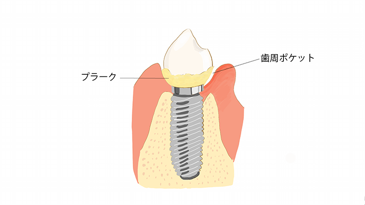 インプラント周囲粘膜炎