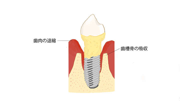 インプラント周囲炎