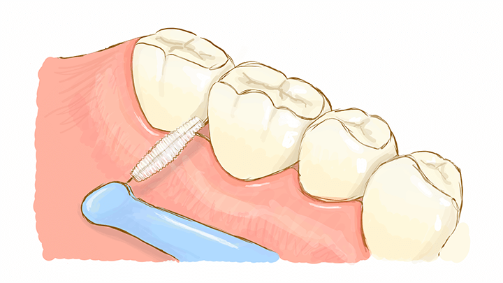 入れる場所・入れ方のイラスト