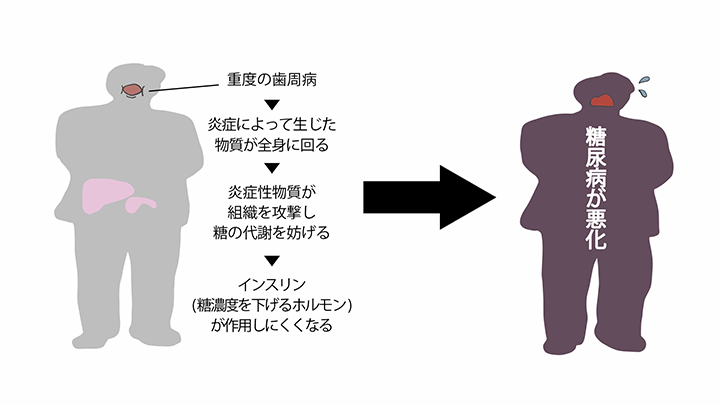 歯周病と糖尿病～歯周病菌で血糖値がUPする～