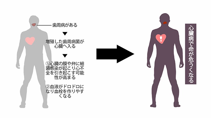 歯周病と心疾患～歯周病菌が心臓を襲う～